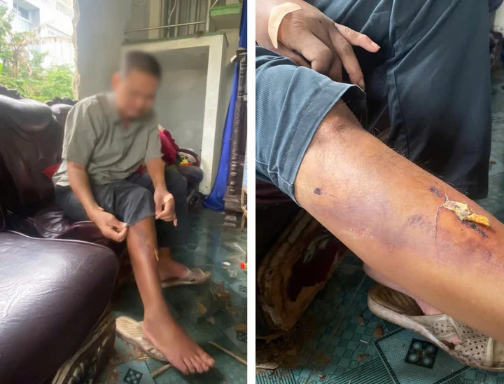 Theo ông H. đây không phải lần đầu ông bị nhóm người trẻ tuổi trên vô cớ đánh đập, trên chân và tay ông hiện còn nhiều vết thương, bầm tím được cho là do nhóm người này gây ra. (Ảnh: Vi Thảo)