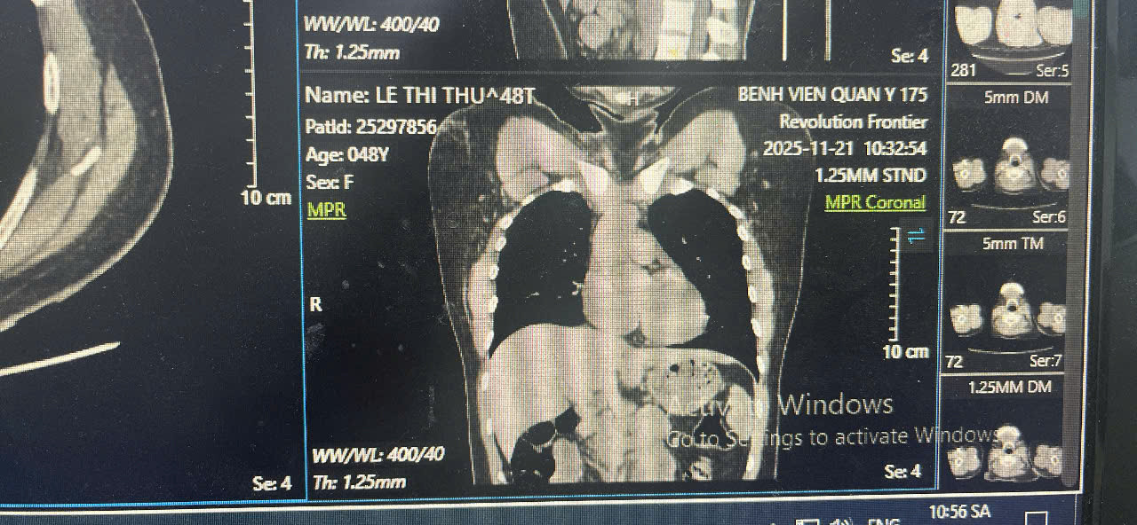 Ống thông truyền hóa chất bị bỏ quên, bị đứt rồi trôi vào tim người phụ nữ - Ảnh 5.