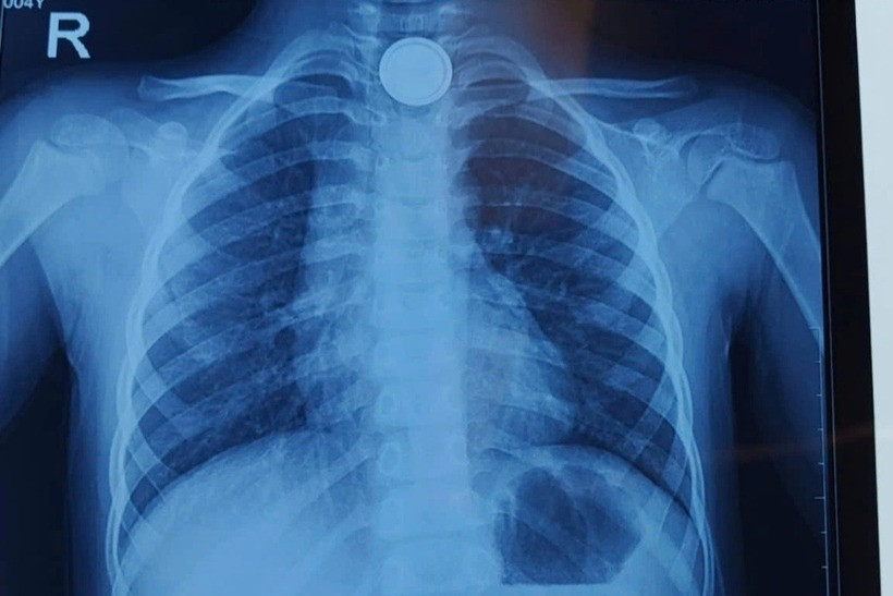 Vị trí pin cúc áo trong cổ bệnh nhi. Ảnh: Dân trí