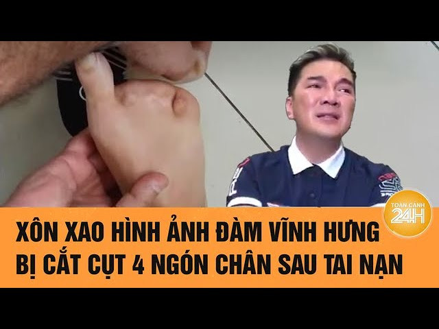 Ca sĩ Đàm Vĩnh Hưng phải cắt cụt 4 ngón chân là thật
- Ảnh 2.