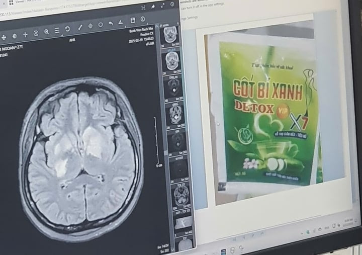Hình ảnh não bị tổn thương và thực phẩm chức năng người phụ nữ uống.