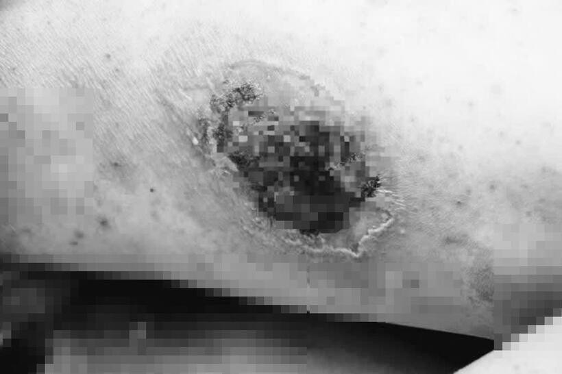 Giã nhỏ kiến ba khoang đắp vào người chữa ngứa, nam thanh niên nhập viện cấp cứu. Ảnh: BVCC.