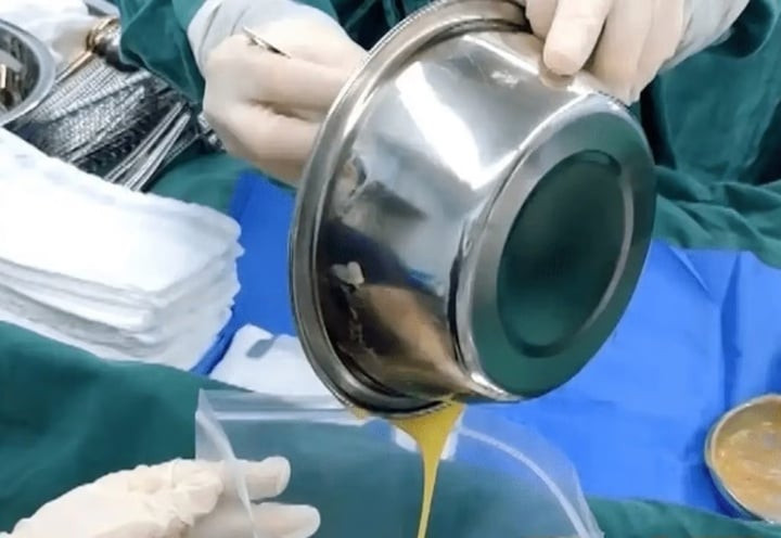 Chất dùng để nâng ngực của Lingling rò rỉ, gây đau đớn cho cô. (Ảnh: 3.15tebiebaodao)