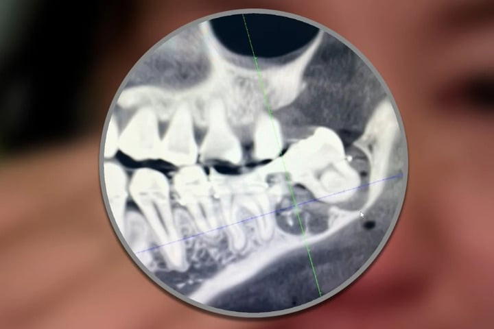 Các bác sĩ nhổ nhầm răng hàm bên cạnh chiếc răng khôn của Wu.