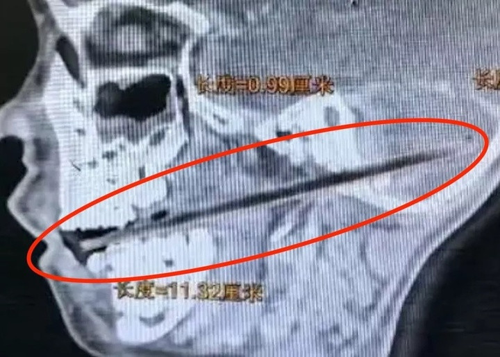 Bị ngã khi ngậm kẹo, cậu bé 6 tuổi bị que kẹo dài 11cm xuyên vào não- Ảnh 1.