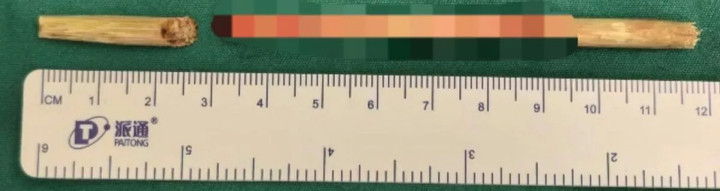 Bị ngã khi ngậm kẹo, cậu bé 6 tuổi bị que kẹo dài 11cm xuyên vào não- Ảnh 2.