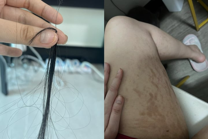 Tình trạng rụng tóc, rạn da của Trúc Anh khiến nhiều khán giả xót xa.