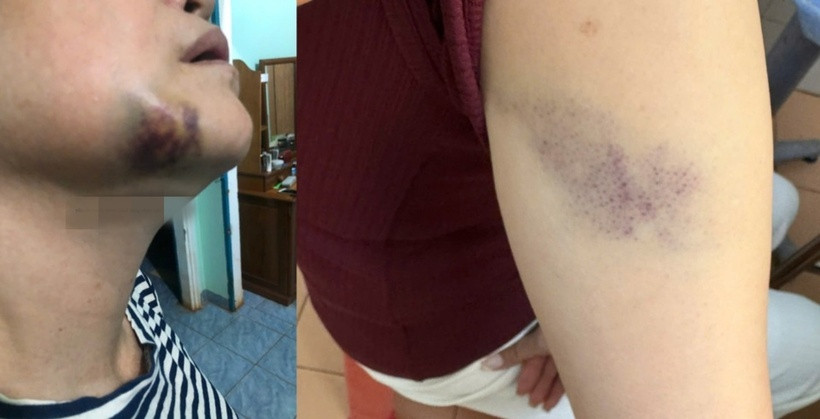 Vết thương của nữ nhân viên y tế sau khi được điều trị. Ảnh: Kinh tế & Đô thị.