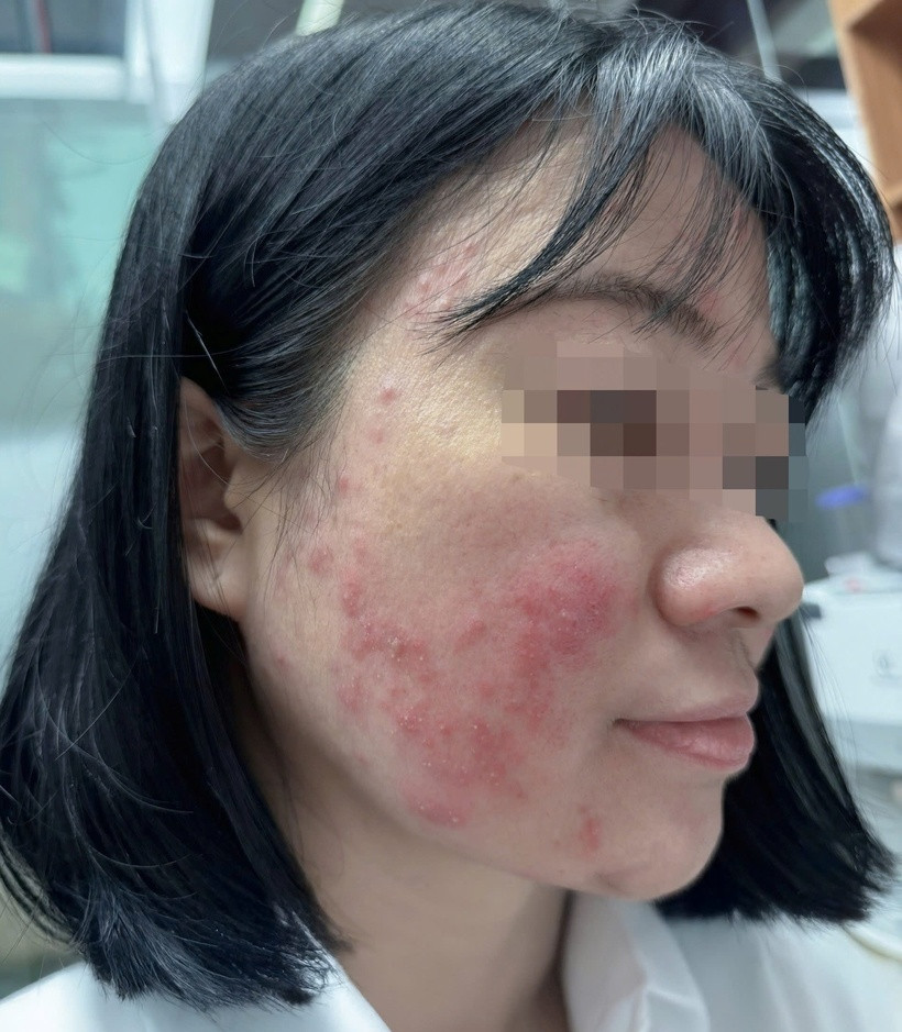 Da của nữ sinh đã bị tổn thương sâu. Ảnh: BSCC