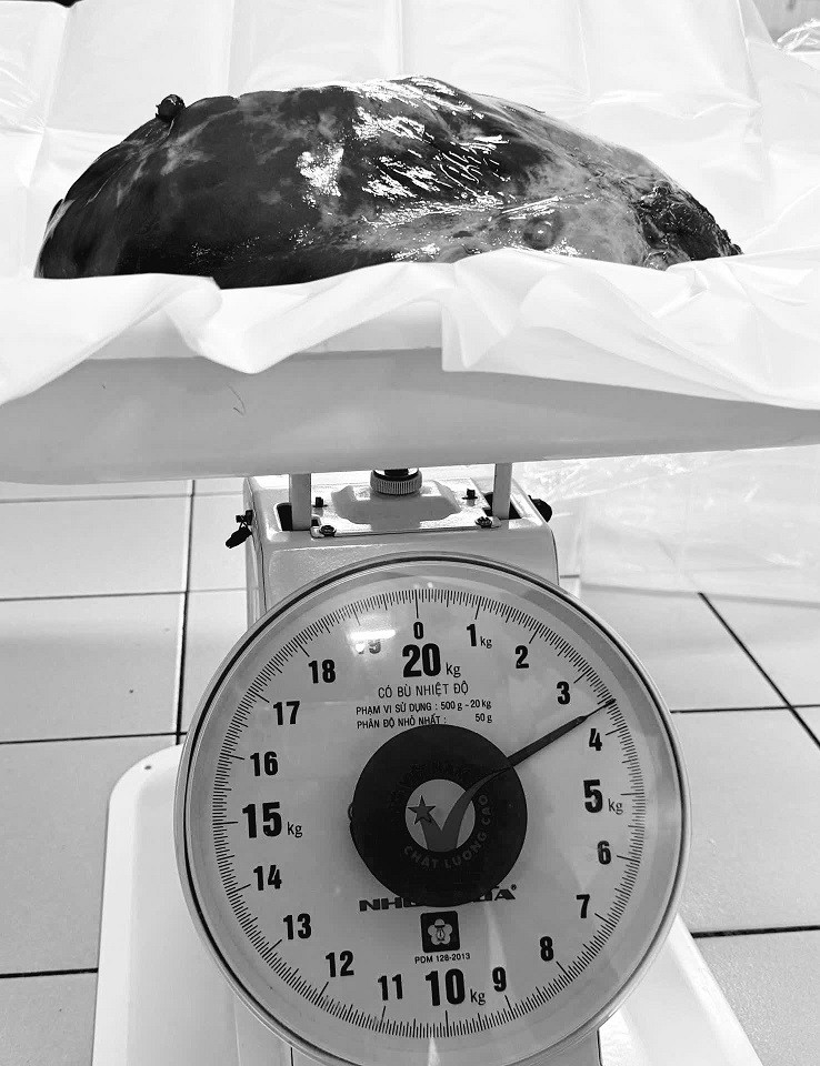 Người đàn ông 42 tuổi mang khối u nặng 3,6kg trong lồng ngực mà không biết - Ảnh 2.