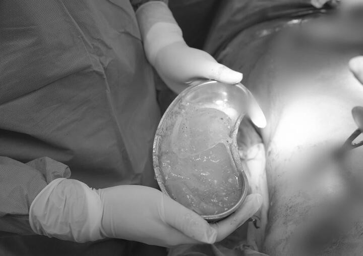 Bác sĩ Nghĩa cùng ekip phẫu thuật tháo bỏ túi vỡ, bóc toàn bộ bao xơ và thay túi ngực mới cho người phụ nữ. (Ảnh: BSCC)