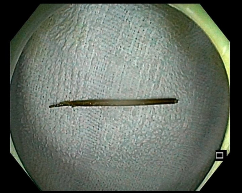 Chiếc tăm nhọn dài 6cm được lấy ra khỏi cơ thể bệnh nhân. Ảnh: Báo Công lý.