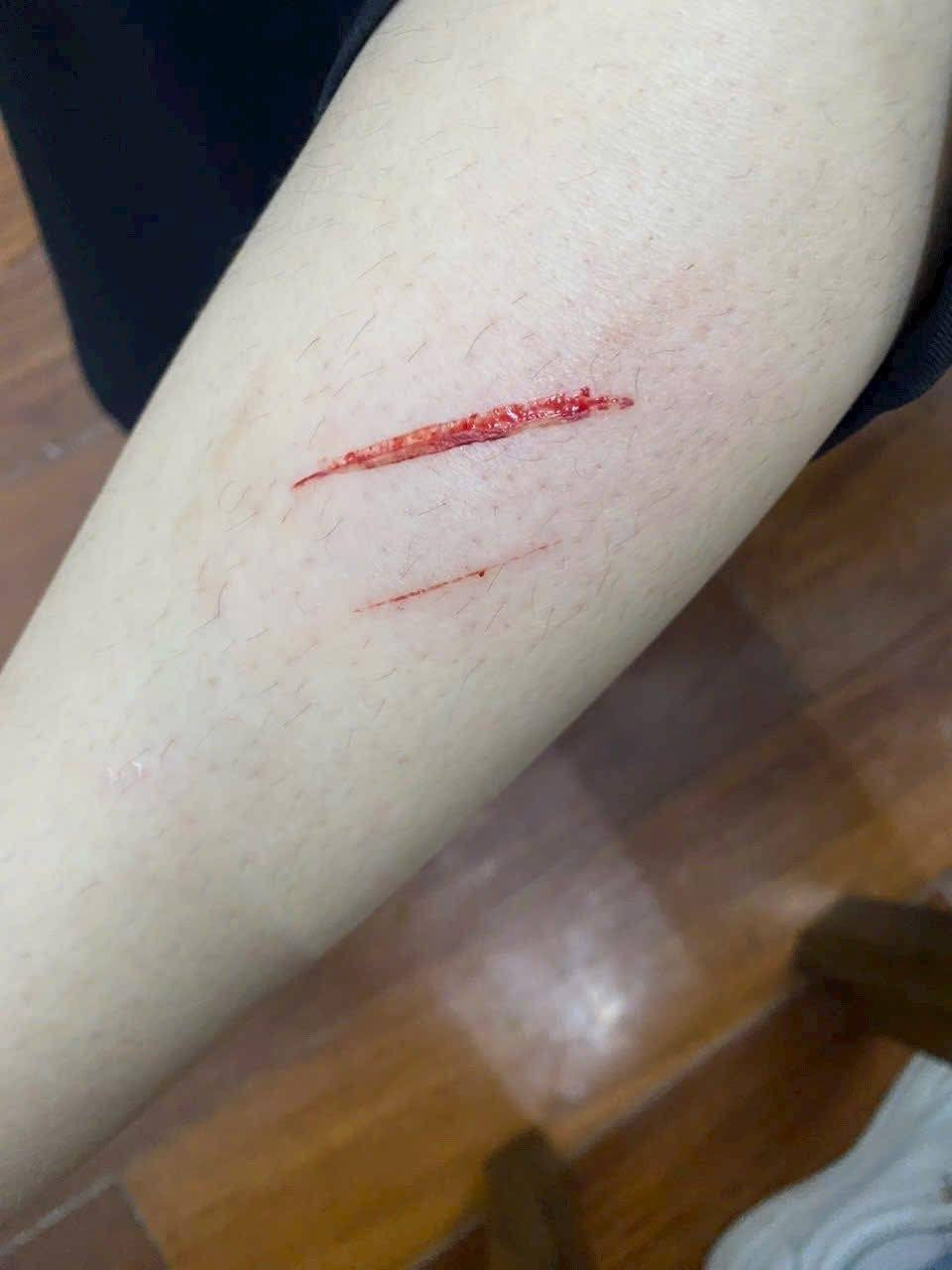 Tình hình sức khoẻ hiện tại của nữ sinh bị đánh nhập viện vì mâu thuẫn