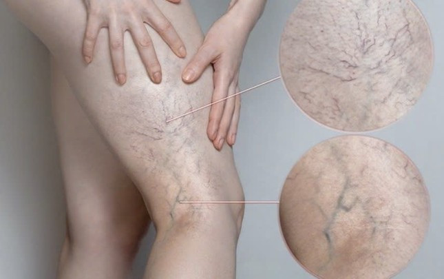 Căn bệnh cực kỳ nguy hiểm 1/3 người Việt trưởng thành có nguy cơ mắc, diễn biến âm thầm khó biết ảnh 1