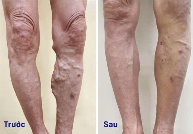 Căn bệnh cực kỳ nguy hiểm 1/3 người Việt trưởng thành có nguy cơ mắc, diễn biến âm thầm khó biết ảnh 3