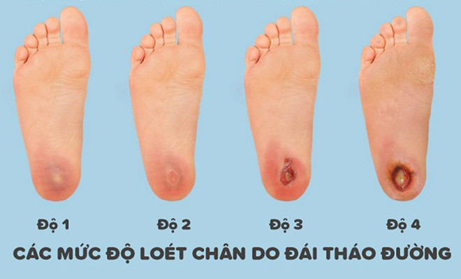 danh gia muc do loet ban chan