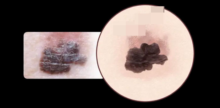 Lưu ý Nốt ruồi ở ba vị trí này có liên quan mật thiết đến ung thư nên xử lý kịp thời