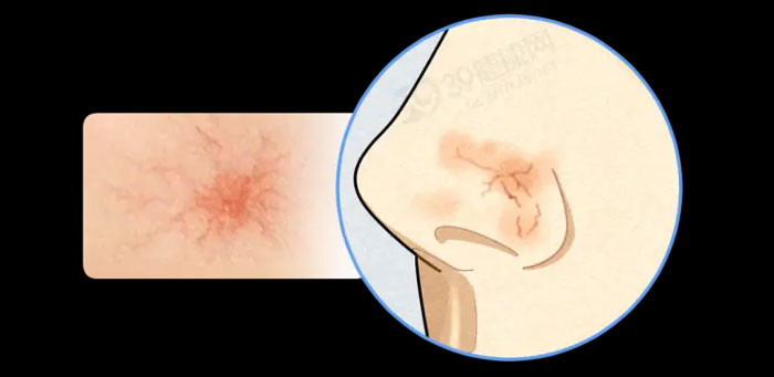 Lưu ý Nốt ruồi ở ba vị trí này có liên quan mật thiết đến ung thư nên xử lý kịp thời