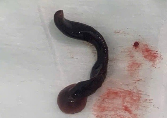 Con đỉa dài 4cm sống trong mũi người đàn ông ảnh 1