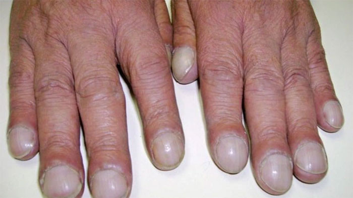 Phổi có khỏe hay không nhìn tay là biết Người bệnh phổi có 5 dấu hiệu bất thường ở bàn tay hãy tự kiểm tra