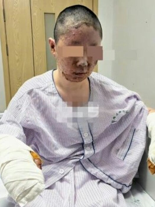 Nữ người mẫu bị bỏng nặng sau vụ nổ khí gas ảnh 2