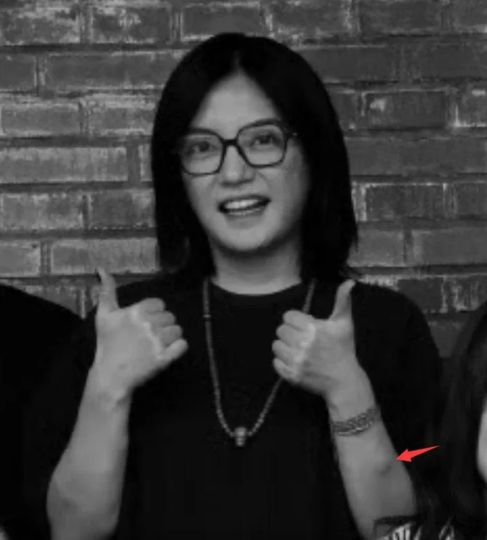 Hình ảnh gần đây của Triệu Vy được cho là nổi u bất thường ở tay. (Ảnh: Thời báo Hoàn Cầu)