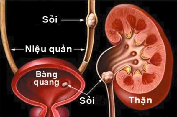 Sỏi tiết niệu hiểm hoạ thầm lặng có thể gây suy thận và tử vong- Ảnh 1.
