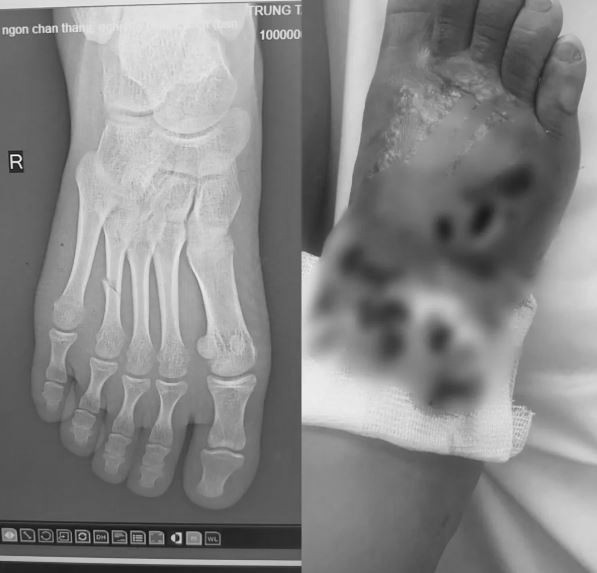 Bé gái 14 tuổi hoại tử chân vì sai lầm phổ biến của nhiều gia đình- Ảnh 1.