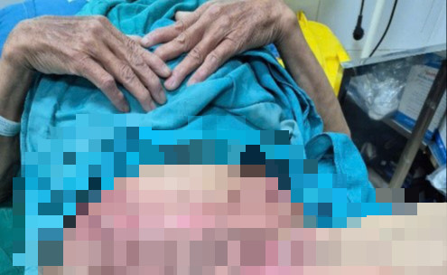 Tự điều trị viêm 'vùng kín', người phụ nữ ở Lạng Sơn bỏng nặng, lở loét toàn bộ vùng sinh dục- Ảnh 1.