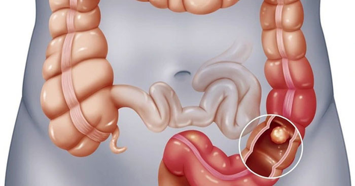 2 loại polyp đại tràng gần như 100 chuyển thành ung thư 4 biểu hiện khi đi vệ sinh cảnh báo nguy hiểm