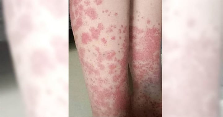 Các đốm tím mọc ở chân rồi lan khắp cơ thể. (Ảnh: Weibo)