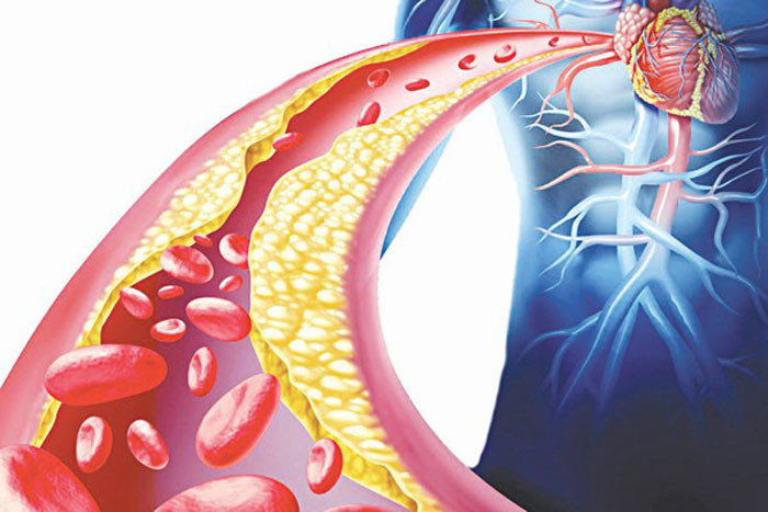 Mỡ máu cao có liên quan đến giấc ngủ Bác sĩ chỉ rõ Người bị mỡ máu cao khi ngủ nhớ 4 không
