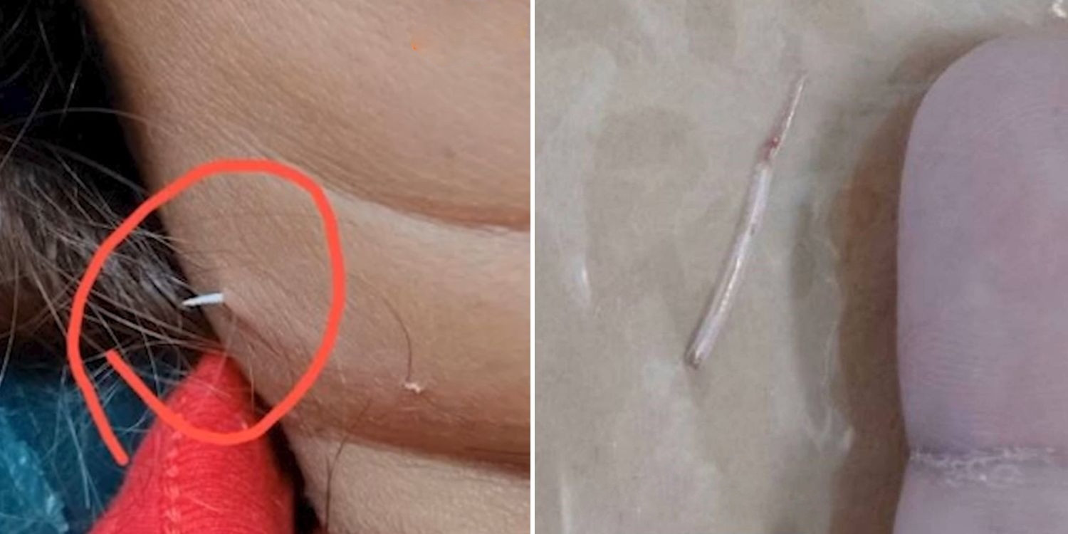 Đau cổ, người phụ nữ sốc nặng khi thấy thứ nhô ra ngoài- Ảnh 1.