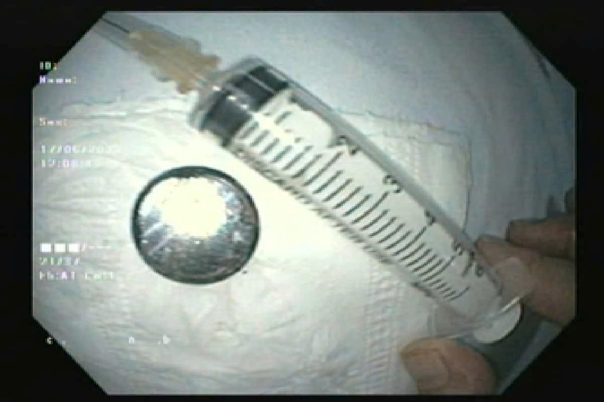 Bé 18 tháng tuổi nhập viện khẩn cấp vì nuốt phải thứ ít ai ngờ tới- Ảnh 1.