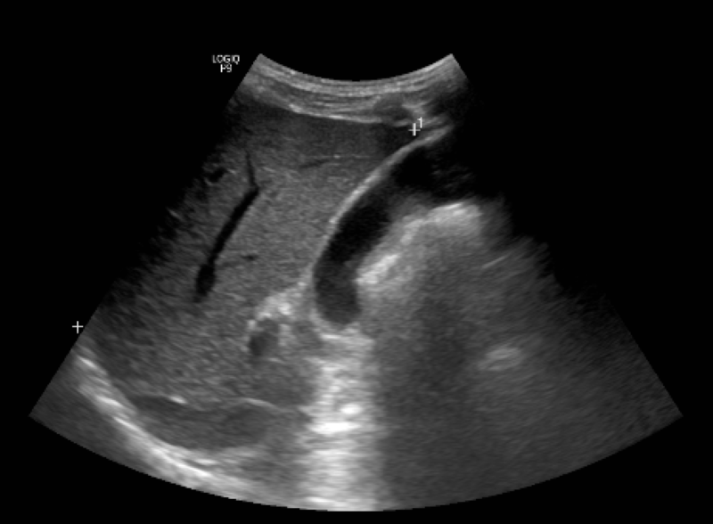 Người đàn ông 34 tuổi ở Hà Nội bị xơ gan thừa nhận 1 sai lầm khi điều trị viêm gan B nhiều người Việt mắc phải  - Ảnh 2.