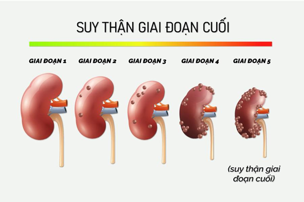 Diễn viên trẻ Ngân Hòa mắc suy thận giai đoạn cuối ở tuổi 29, căn bệnh của cô nguy hiểm thế nào? - Ảnh 3.
