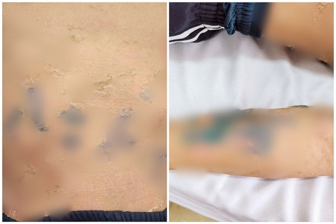 Tự đắp lá chữa bệnh sởi, nam thanh niên 17 tuổi nhập viện gấp- Ảnh 1.