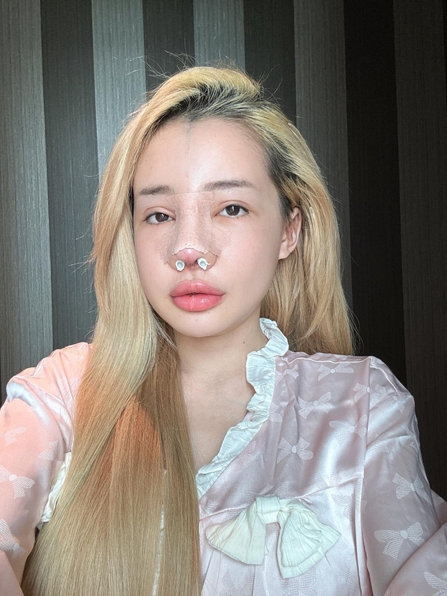 Sóc gương mặt biến dạng phải điều gấp của Ngân 98 sau hơn 10 lần dao kéo