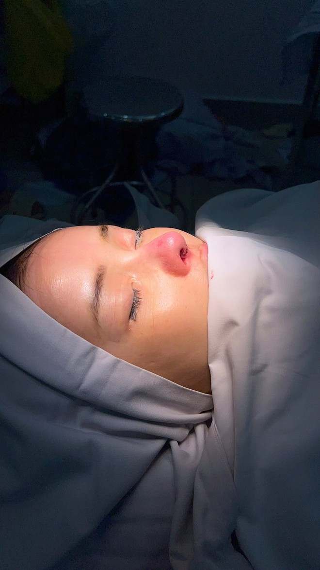 Sóc gương mặt biến dạng phải điều gấp của Ngân 98 sau hơn 10 lần dao kéo