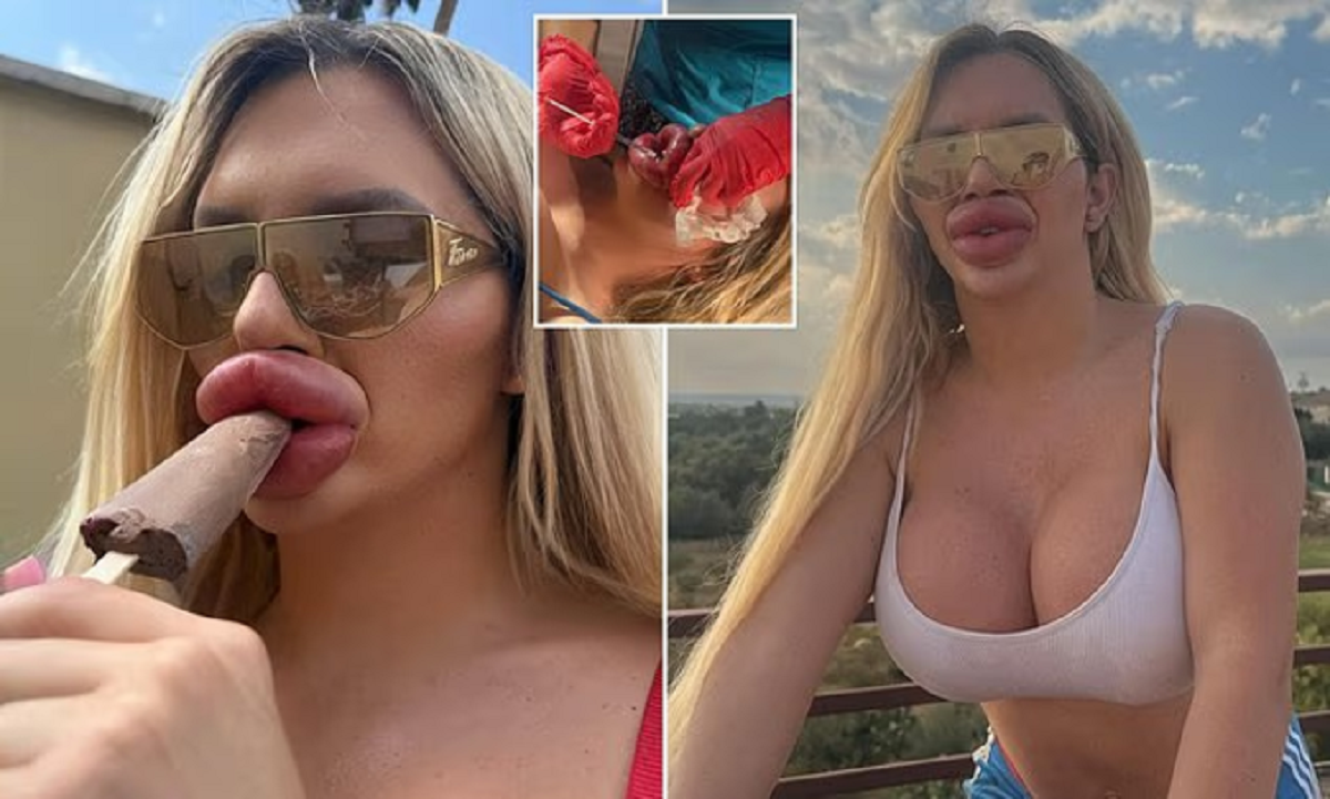 Bỏ 1,3 tỷ đồng bơm môi, cô gái trẻ bất ngờ với kết quả