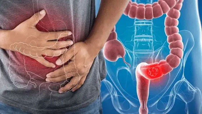 Tưởng rối loạn tiêu hóa ai ngờ là ung thư 5 dấu hiệu trực tràng không nên xem thường