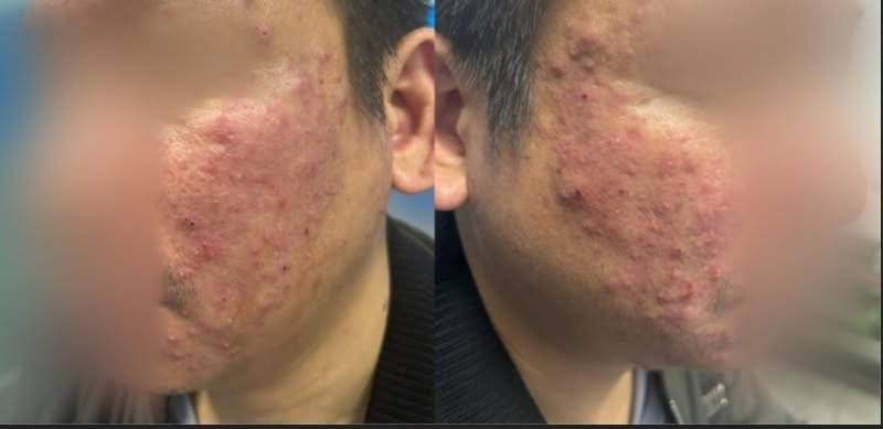 Tưởng mụn trứng cá, người đàn ông đi khám phát hiện