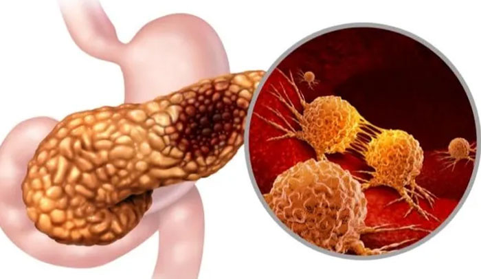 4 dấu hiệu cảnh báo ung thư tuyến tụy nhiều người bỏ qua vì tưởng bình thường