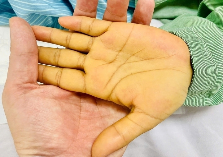 Một trong những biểu hiện đầu tiên thường gặp là vàng da. (Ảnh minh hoạ: Thanh Đặng)