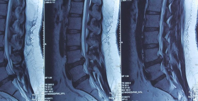 Cô gái 23 tuổi suýt liệt chân vì điều trị thoát vị đĩa đệm sai cách - Ảnh 2.