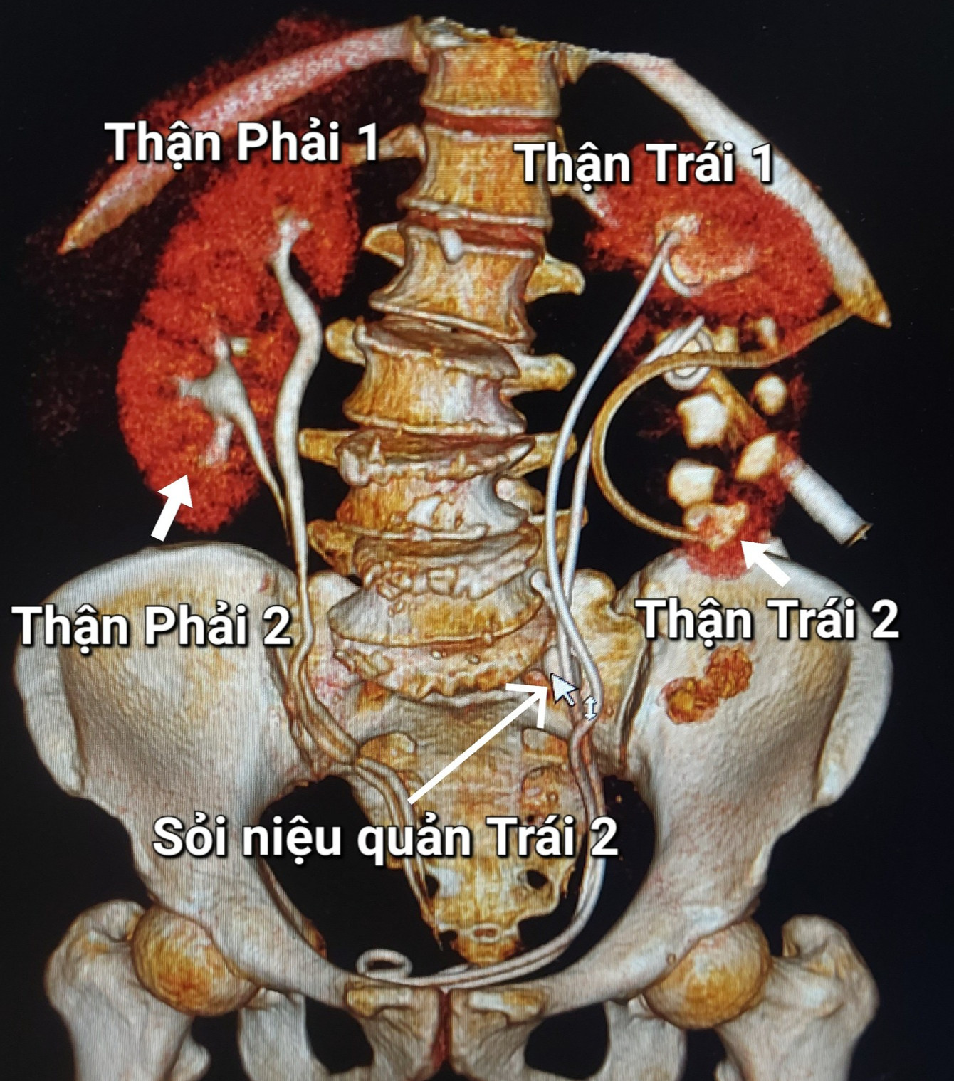 Người phụ nữ được phát hiện có 4 quả thận khi khám đau lưng- Ảnh 1.
