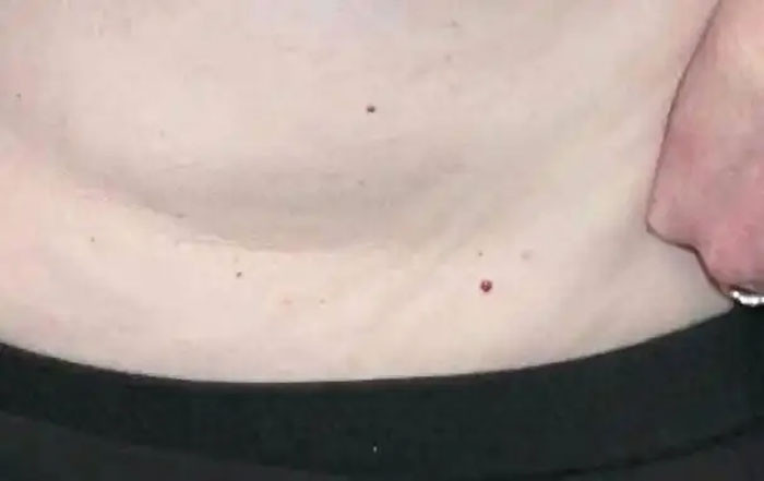 Nốt ruồi son xuất hiện trên cơ thể dấu hiệu của bệnh nguy hiểm Bác sĩ Nếu có 3 đặc điểm bất thường cần đi khám