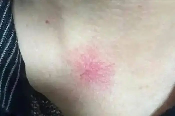 Nốt ruồi son xuất hiện trên cơ thể dấu hiệu của bệnh nguy hiểm Bác sĩ Nếu có 3 đặc điểm bất thường cần đi khám