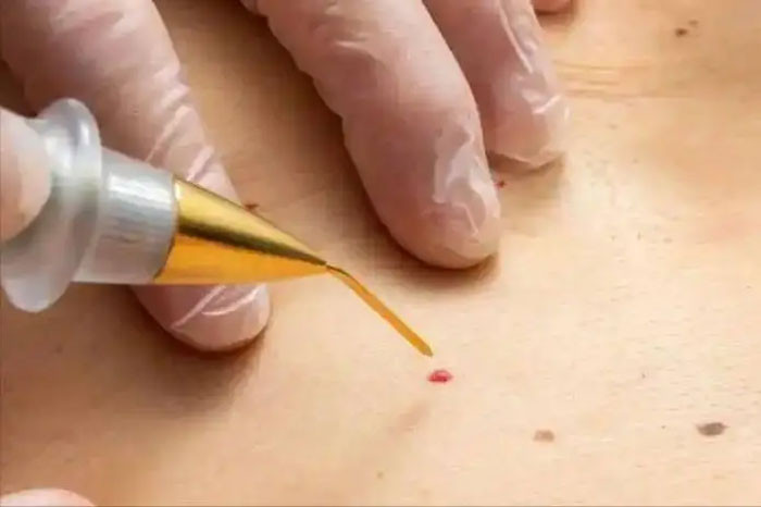 Nốt ruồi son xuất hiện trên cơ thể dấu hiệu của bệnh nguy hiểm Bác sĩ Nếu có 3 đặc điểm bất thường cần đi khám