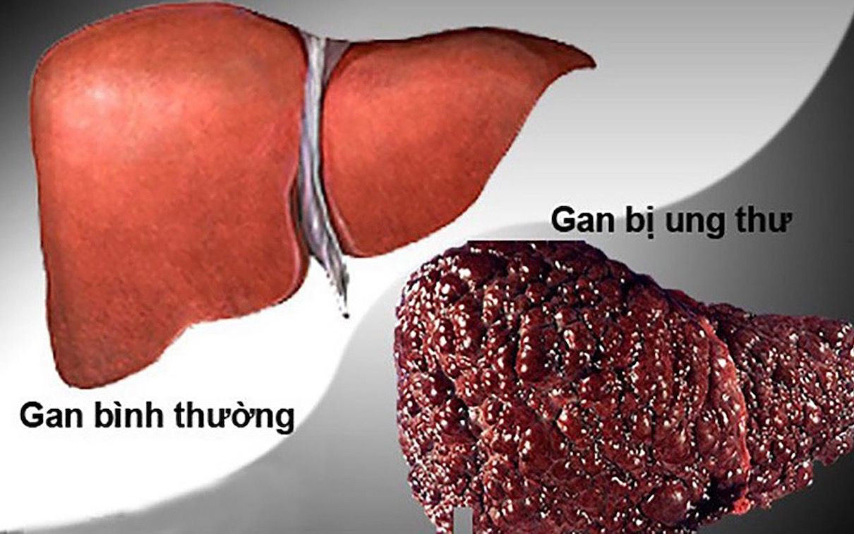 Lên mạng tìm thầy chữa ung thư gan, người đàn ông 37 tuổi ở Hà Nội qua đời trong sự đau xót của người thân